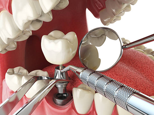 Best Emergency Tooth Extraction in Harlan, IA